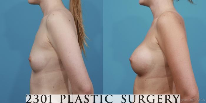 Before & After Breast Augmentation Case 368 View #2 View in Fort Worth, Plano, & Frisco, Texas