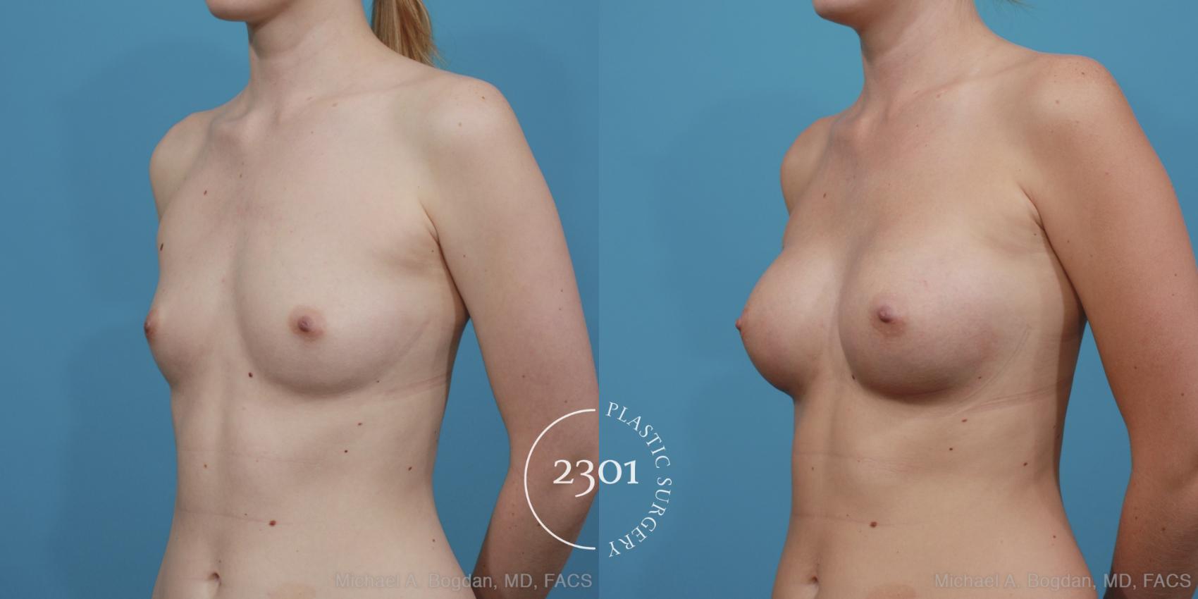 Before & After Breast Augmentation Case 368 View #3 View in Fort Worth, Plano, & Frisco, Texas