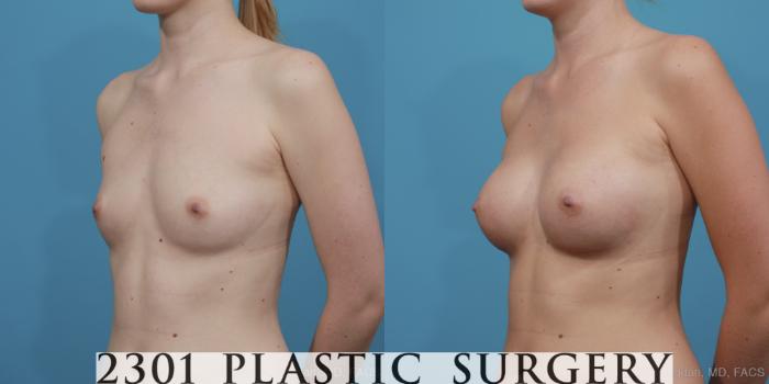 Before & After Breast Augmentation Case 368 View #3 View in Fort Worth, Plano, & Frisco, Texas