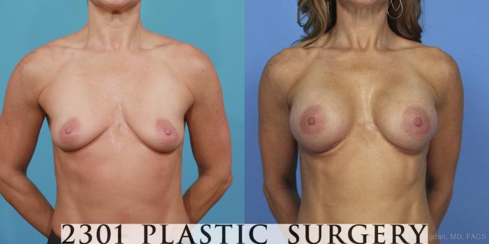 Before & After Silicone Implants Case 371 View #1 View in Fort Worth, Plano, & Frisco, Texas