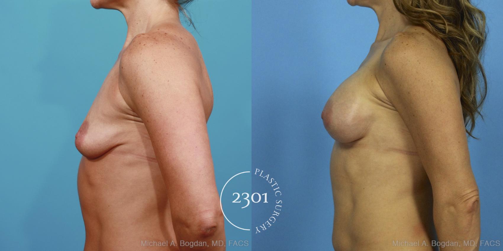 Before & After Silicone Implants Case 371 View #2 View in Fort Worth, Plano, & Frisco, Texas