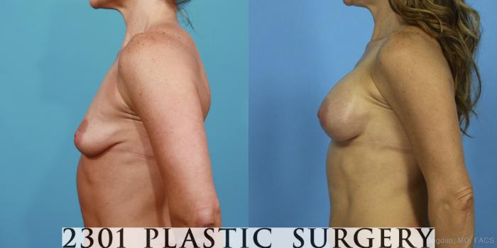 Before & After Silicone Implants Case 371 View #2 View in Fort Worth, Plano, & Frisco, Texas