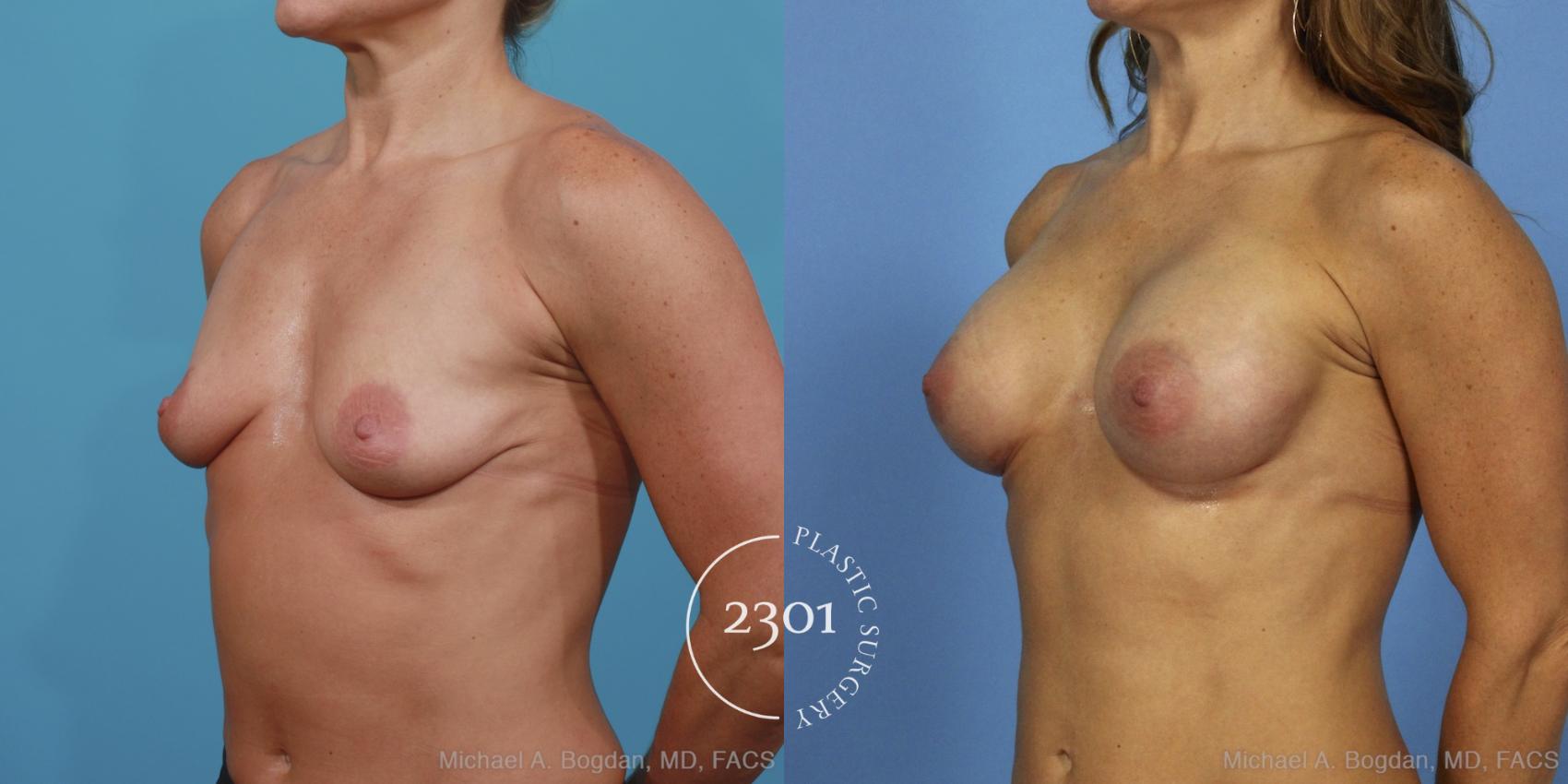 Before & After Silicone Implants Case 371 View #3 View in Fort Worth, Plano, & Frisco, Texas