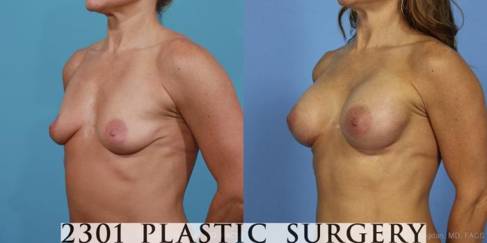 Before & After Silicone Implants Case 371 View #3 View in Fort Worth, Plano, & Frisco, Texas