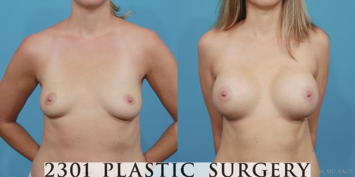 Before & After Silicone Implants Case 374 View #1 View in Fort Worth, Plano, & Frisco, Texas