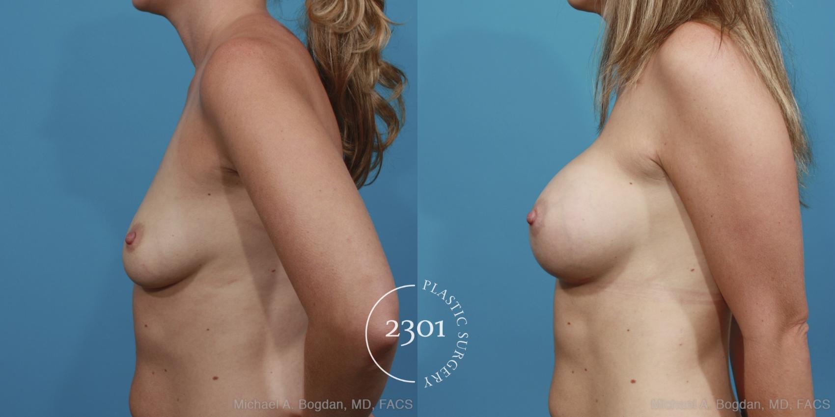 Before & After Silicone Implants Case 374 View #2 View in Fort Worth, Plano, & Frisco, Texas