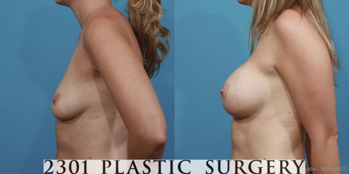 Before & After Silicone Implants Case 374 View #2 View in Fort Worth, Plano, & Frisco, Texas
