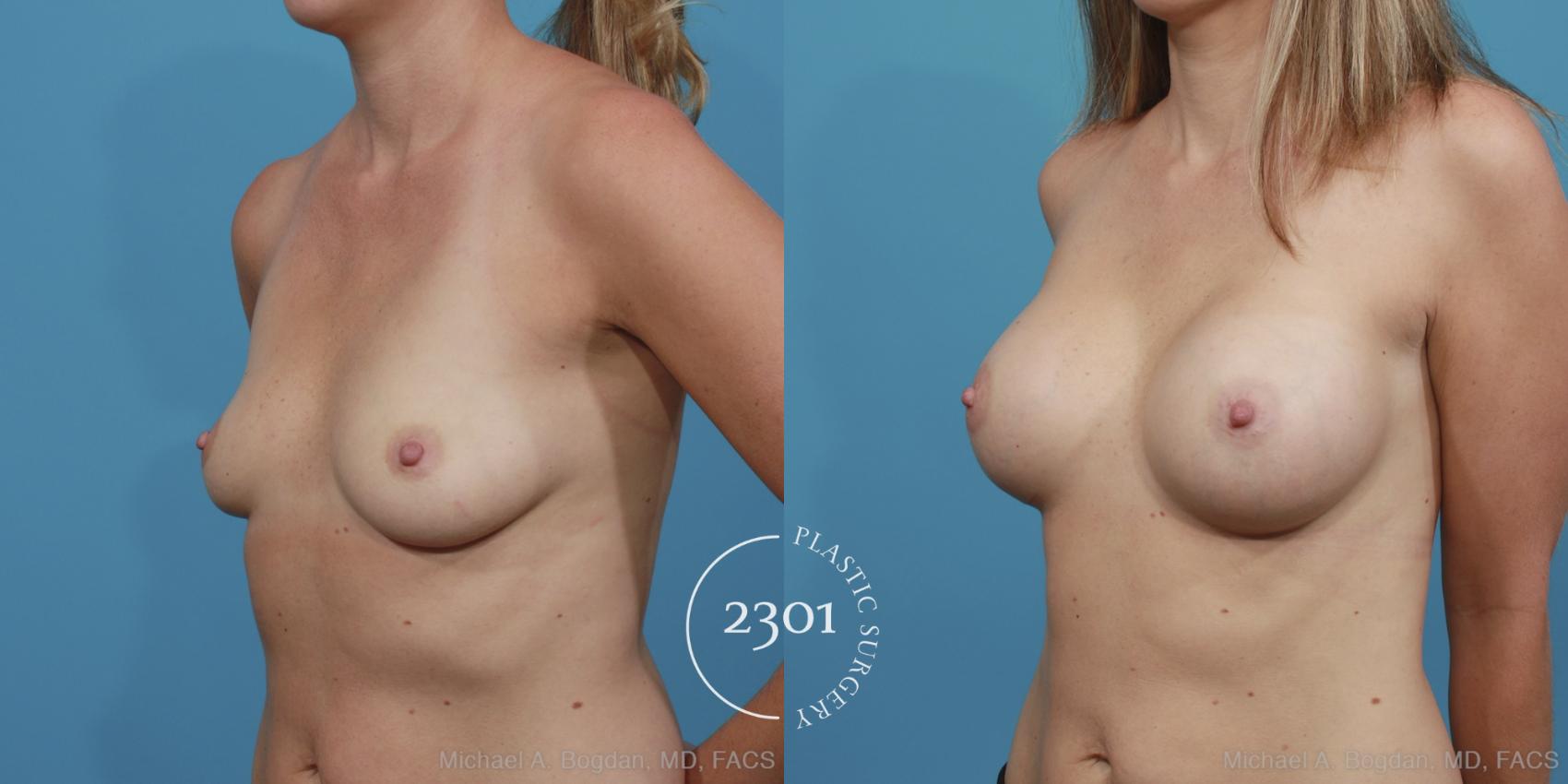 Before & After Silicone Implants Case 374 View #3 View in Fort Worth, Plano, & Frisco, Texas