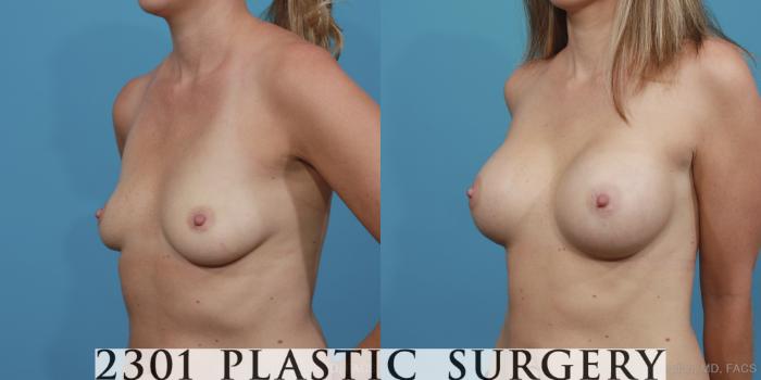Before & After Silicone Implants Case 374 View #3 View in Fort Worth, Plano, & Frisco, Texas