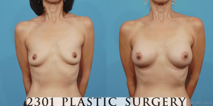 Before & After Silicone Implants Case 379 View #1 View in Fort Worth, Plano, & Frisco, Texas