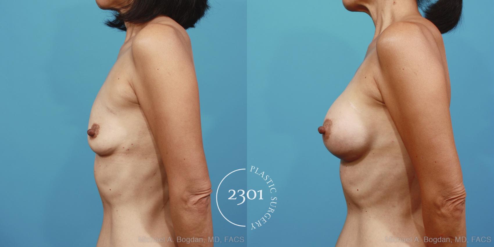 Before & After Breast Augmentation Case 379 View #2 View in Fort Worth, Plano, & Frisco, Texas