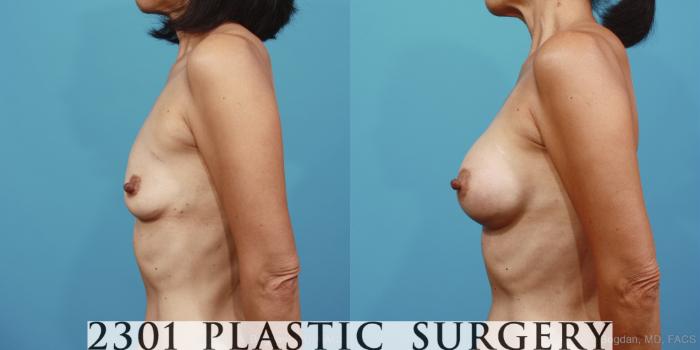 Before & After Silicone Implants Case 379 View #2 View in Fort Worth, Plano, & Frisco, Texas