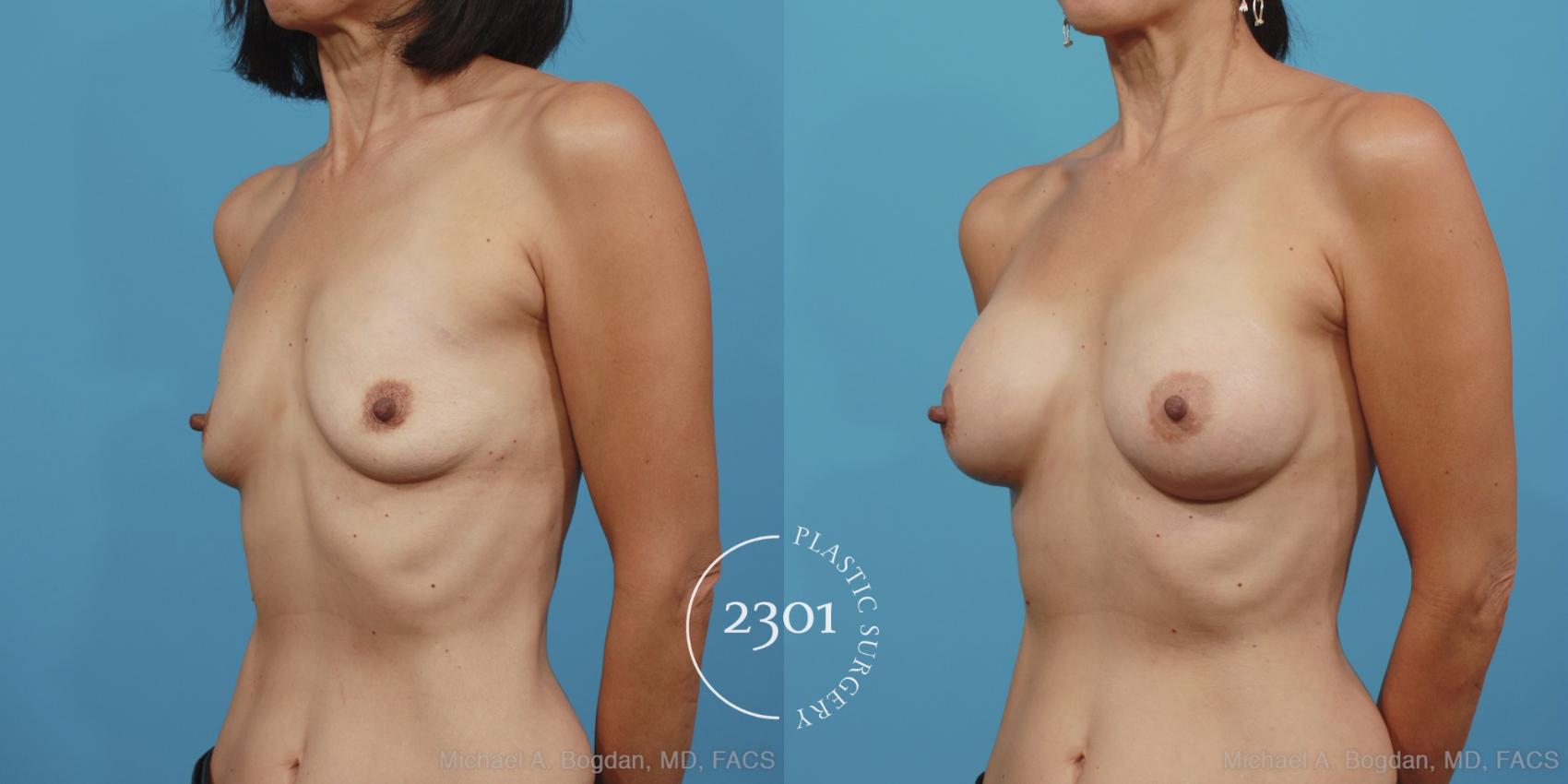 Before & After Breast Augmentation Case 379 View #3 View in Fort Worth, Plano, & Frisco, Texas