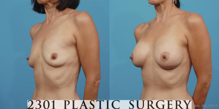 Before & After Breast Augmentation Case 379 View #3 View in Fort Worth, Plano, & Frisco, Texas