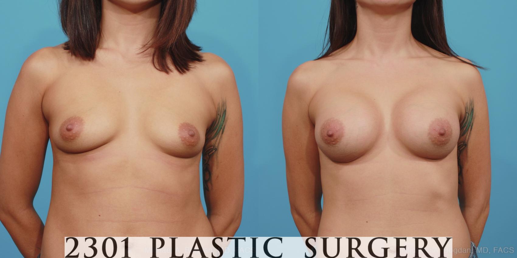 Before & After Silicone Implants Case 381 View #1 View in Fort Worth, Plano, & Frisco, Texas