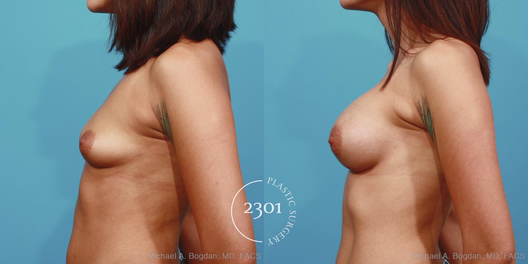 Before & After Silicone Implants Case 381 View #2 View in Fort Worth, Plano, & Frisco, Texas