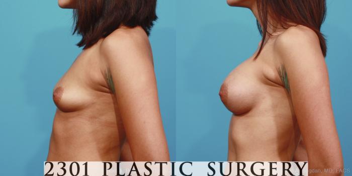Before & After Silicone Implants Case 381 View #2 View in Fort Worth, Plano, & Frisco, Texas