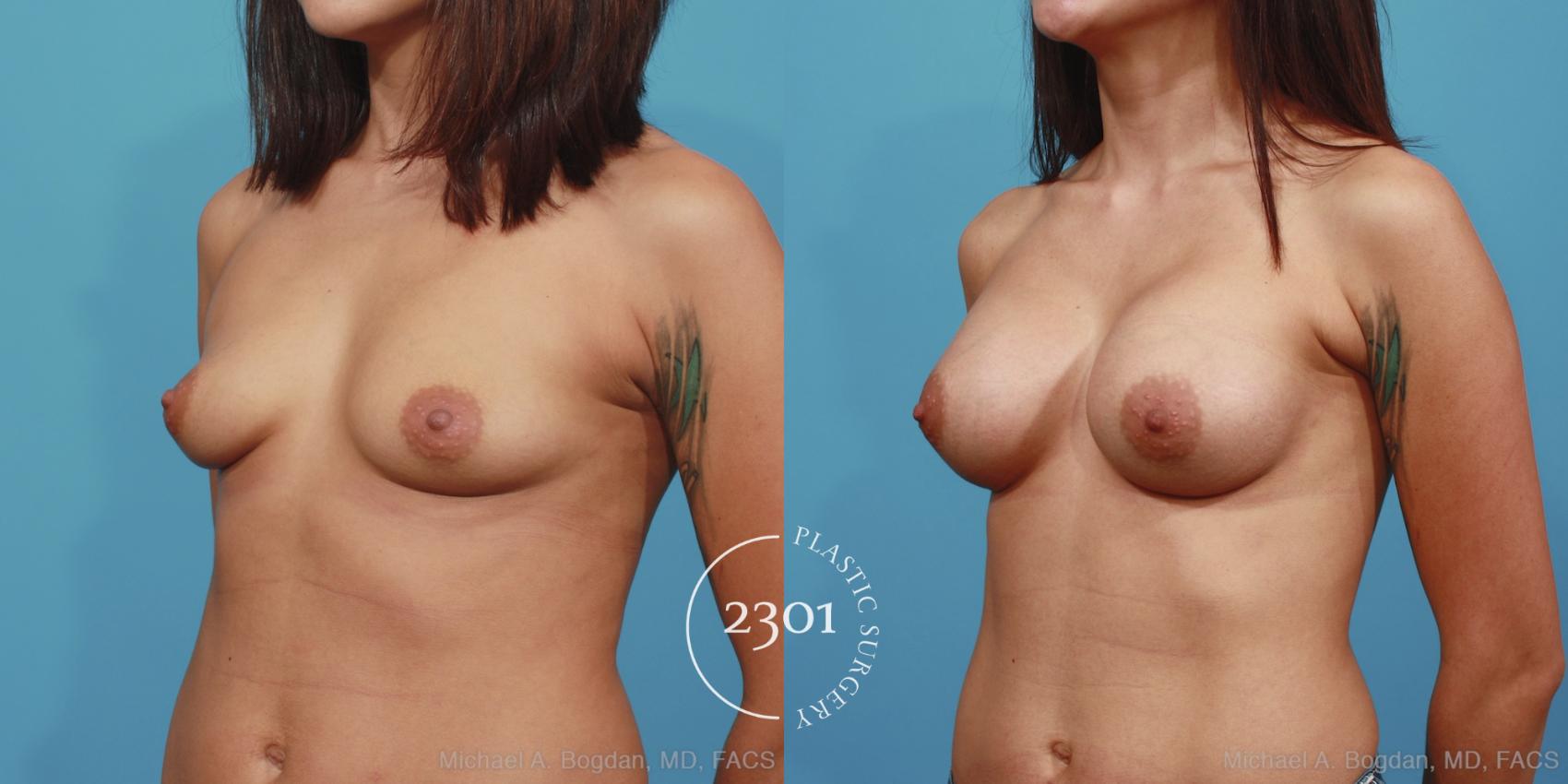 Before & After Silicone Implants Case 381 View #3 View in Fort Worth, Plano, & Frisco, Texas