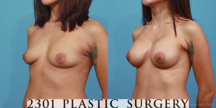 Before & After Breast Augmentation Case 381 View #3 View in Fort Worth, Plano, & Frisco, Texas