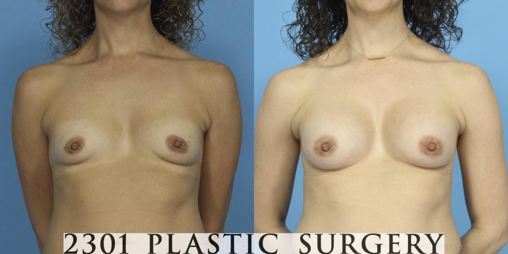 Before & After Silicone Implants Case 387 View #1 View in Fort Worth, Plano, & Frisco, Texas
