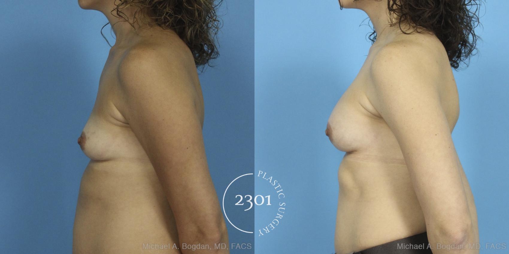Before & After Silicone Implants Case 387 View #2 View in Fort Worth, Plano, & Frisco, Texas