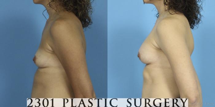 Before & After Breast Augmentation Case 387 View #2 View in Fort Worth, Plano, & Frisco, Texas