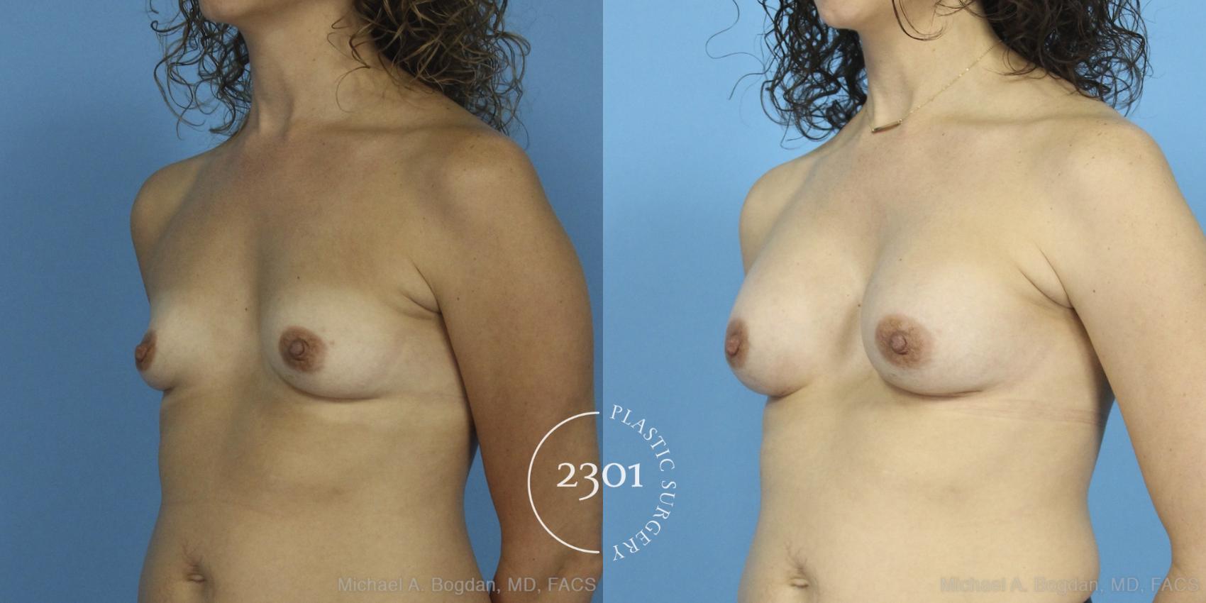 Before & After Silicone Implants Case 387 View #3 View in Fort Worth, Plano, & Frisco, Texas