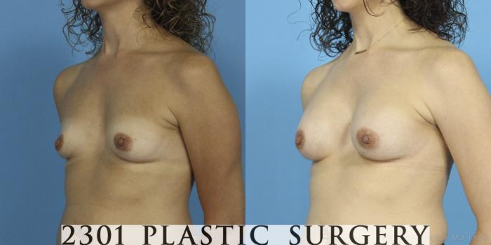 Before & After Breast Augmentation Case 387 View #3 View in Fort Worth, Plano, & Frisco, Texas