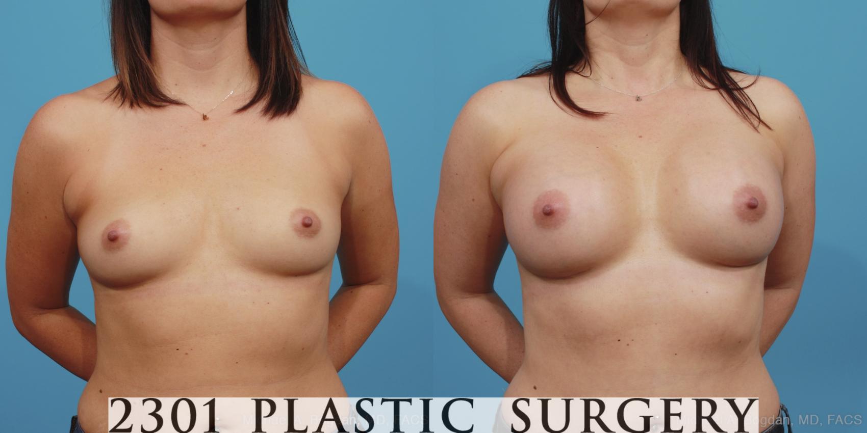 Before & After Breast Augmentation Case 388 View #1 View in Fort Worth, Plano, & Frisco, Texas