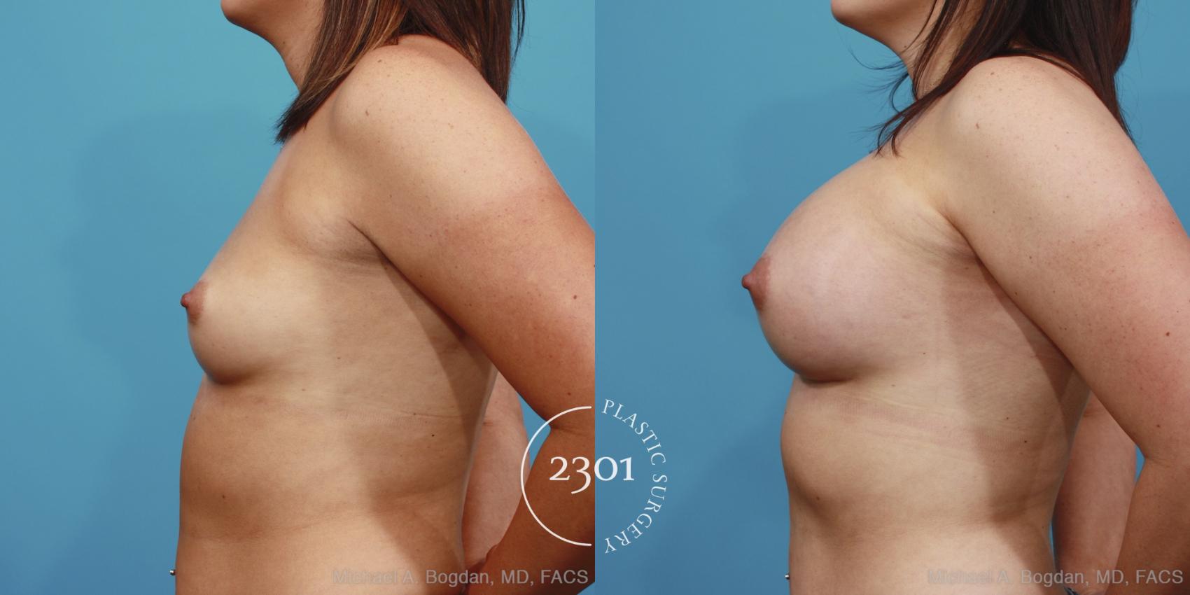 Before & After Silicone Implants Case 388 View #2 View in Fort Worth, Plano, & Frisco, Texas