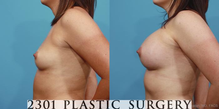 Before & After Silicone Implants Case 388 View #2 View in Fort Worth, Plano, & Frisco, Texas