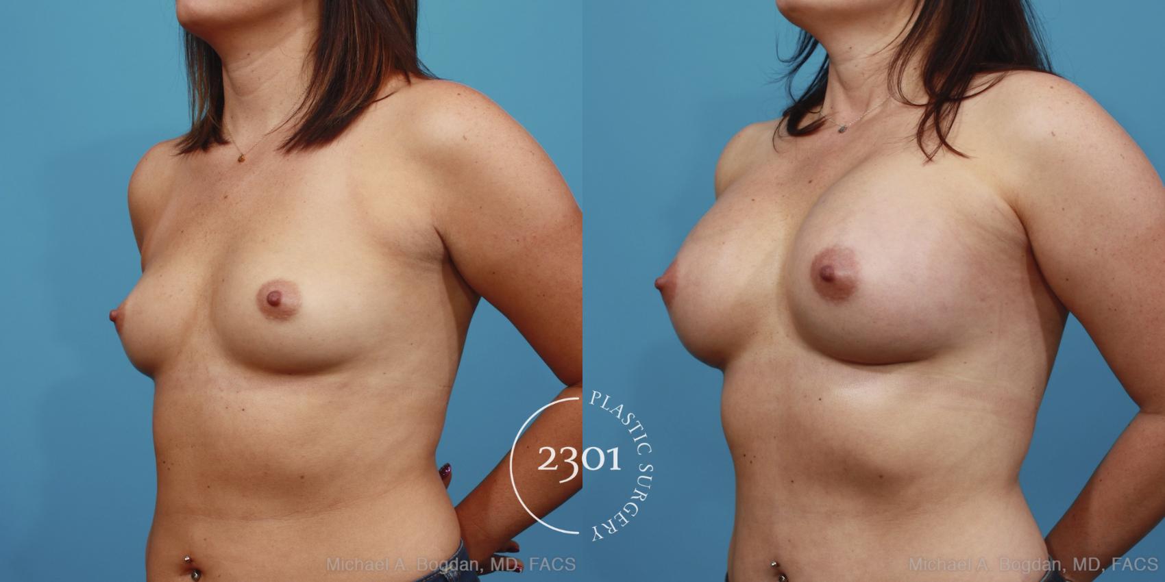 Before & After Silicone Implants Case 388 View #3 View in Fort Worth, Plano, & Frisco, Texas