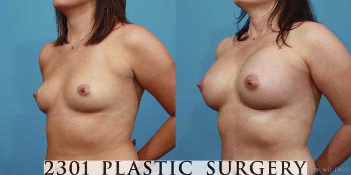 Before & After Breast Augmentation Case 388 View #3 View in Fort Worth, Plano, & Frisco, Texas
