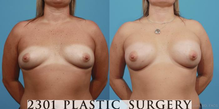 Before & After Silicone Implants Case 393 View #1 View in Fort Worth, Plano, & Frisco, Texas