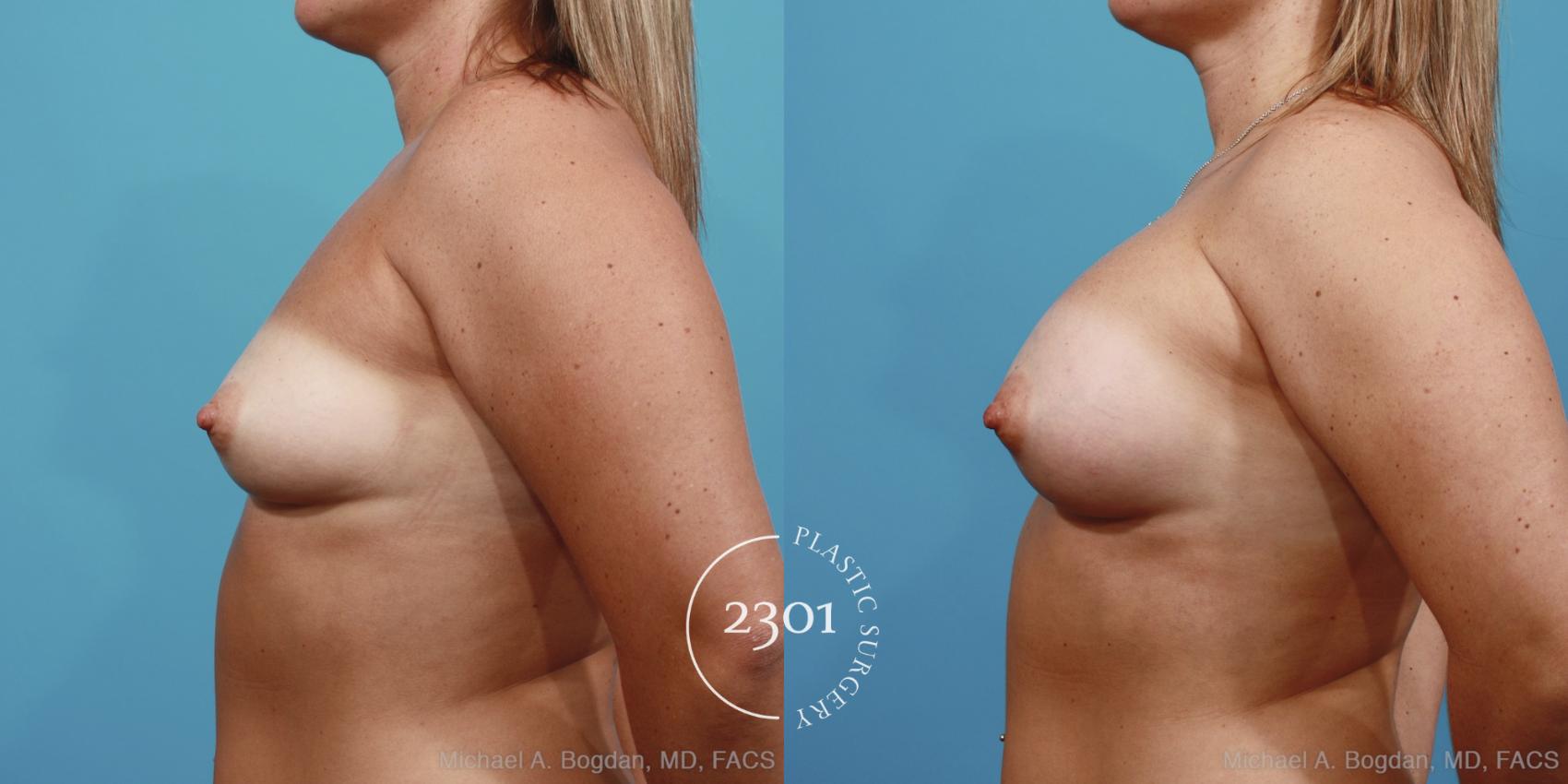 Before & After Silicone Implants Case 393 View #2 View in Fort Worth, Plano, & Frisco, Texas
