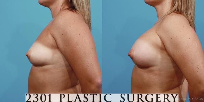 Before & After Silicone Implants Case 393 View #2 View in Fort Worth, Plano, & Frisco, Texas