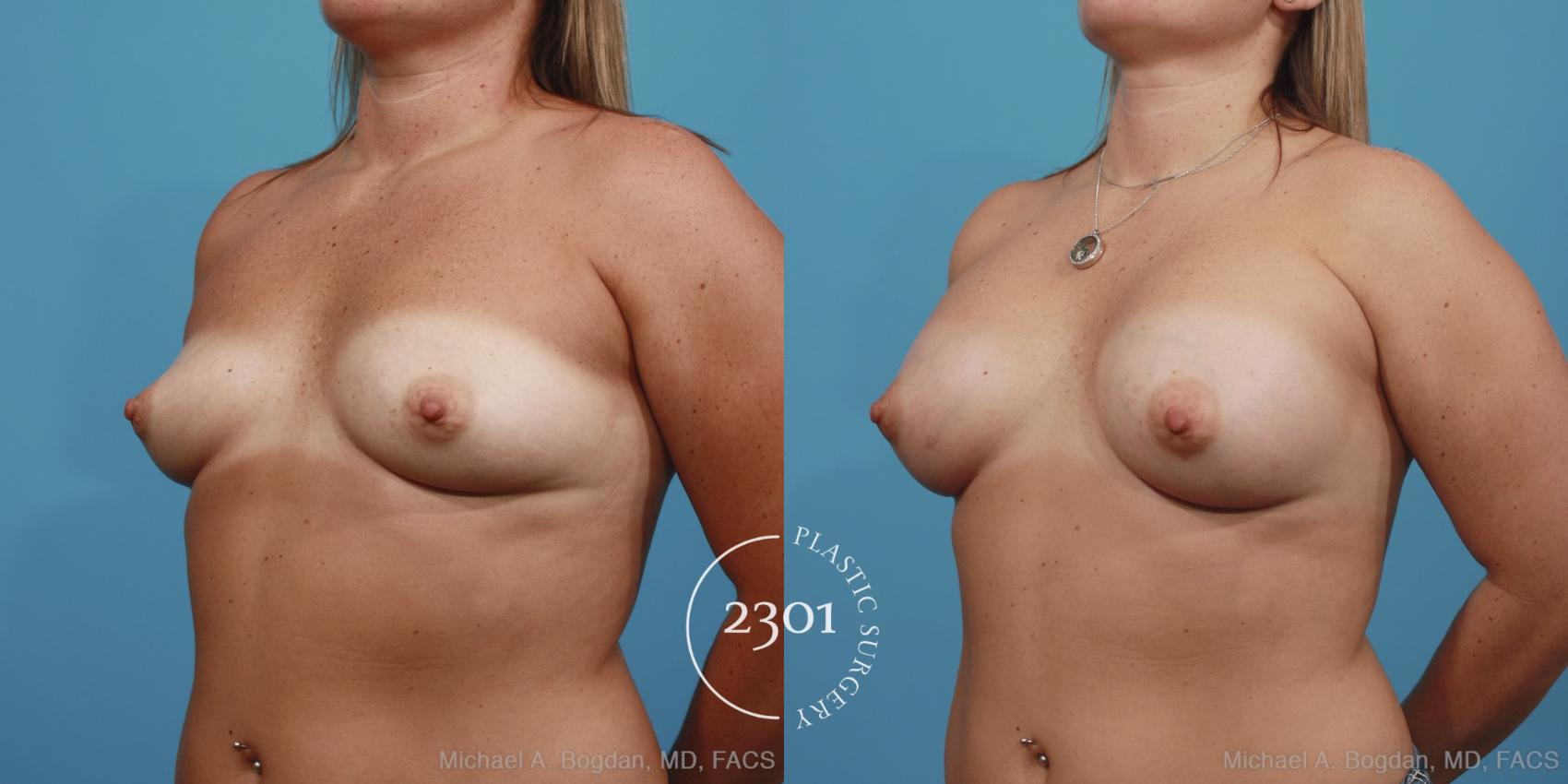 Before & After Silicone Implants Case 393 View #3 View in Fort Worth, Plano, & Frisco, Texas