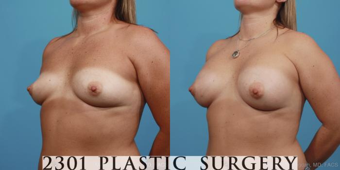 Before & After Silicone Implants Case 393 View #3 View in Fort Worth, Plano, & Frisco, Texas