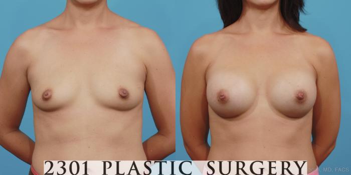 Before & After Silicone Implants Case 394 View #1 View in Fort Worth, Plano, & Frisco, Texas