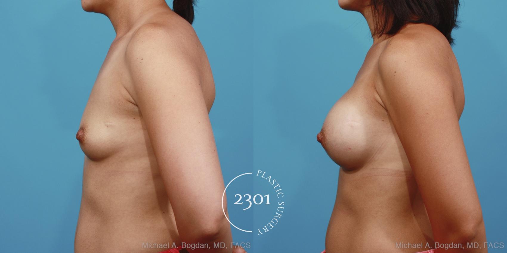 Before & After Silicone Implants Case 394 View #2 View in Fort Worth, Plano, & Frisco, Texas