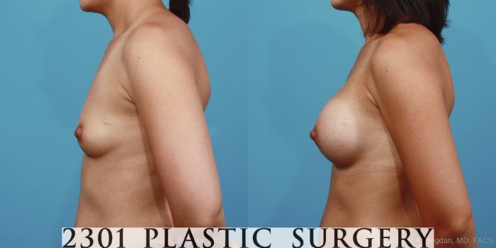 Before & After Silicone Implants Case 394 View #2 View in Fort Worth, Plano, & Frisco, Texas