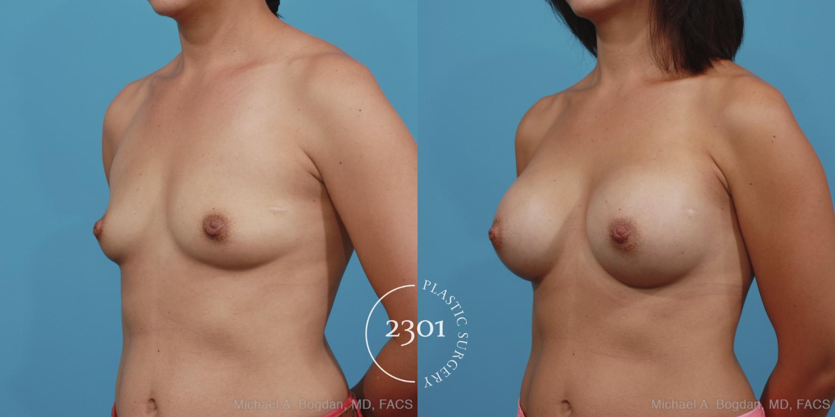 Before & After Silicone Implants Case 394 View #3 View in Fort Worth, Plano, & Frisco, Texas