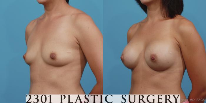 Before & After Silicone Implants Case 394 View #3 View in Fort Worth, Plano, & Frisco, Texas