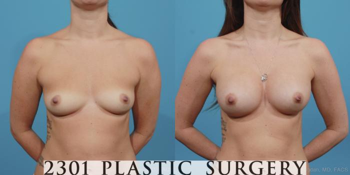 Before & After Silicone Implants Case 395 View #1 View in Fort Worth, Plano, & Frisco, Texas