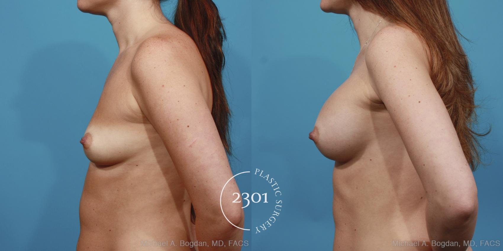 Before & After Silicone Implants Case 395 View #2 View in Fort Worth, Plano, & Frisco, Texas