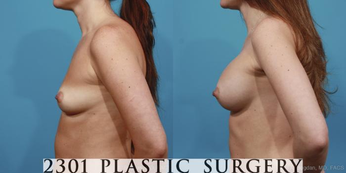 Before & After Silicone Implants Case 395 View #2 View in Fort Worth, Plano, & Frisco, Texas