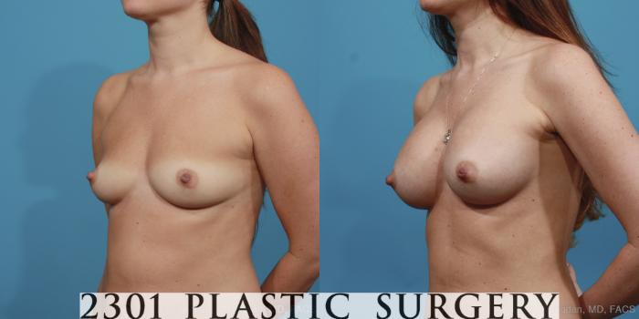 Before & After Silicone Implants Case 395 View #3 View in Fort Worth, Plano, & Frisco, Texas