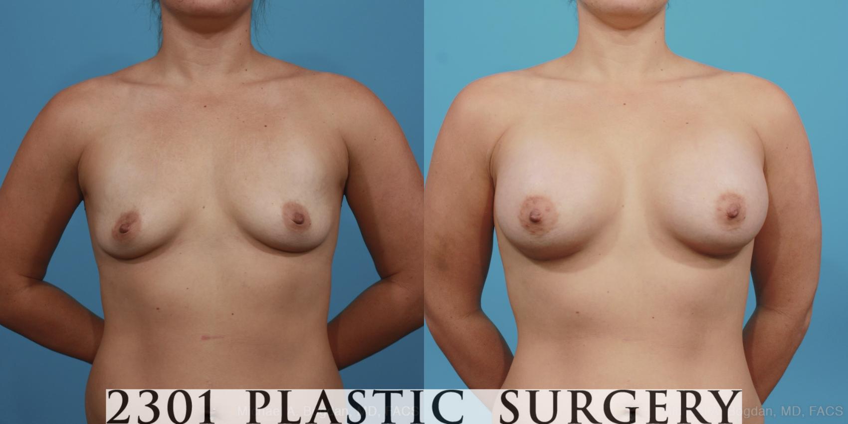 Before & After Silicone Implants Case 401 View #1 View in Fort Worth, Plano, & Frisco, Texas