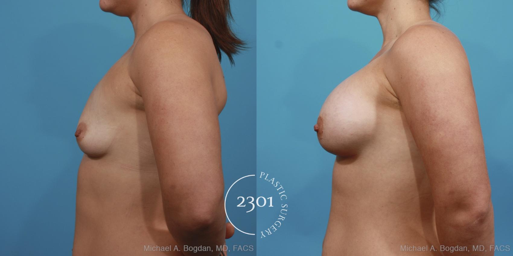 Before & After Silicone Implants Case 401 View #2 View in Fort Worth, Plano, & Frisco, Texas