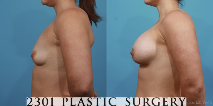 Before & After Silicone Implants Case 401 View #2 View in Fort Worth, Plano, & Frisco, Texas